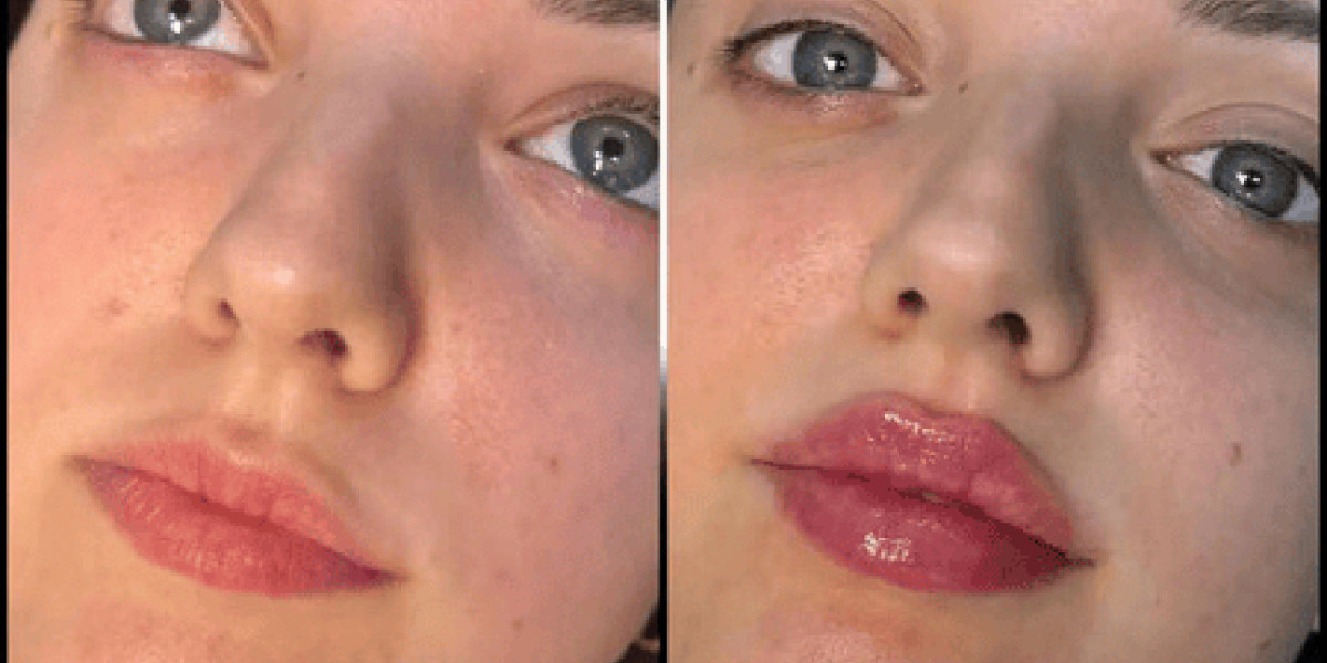 Best Doctors in dubai for Fillers: Expert Anti-Aging Solutions