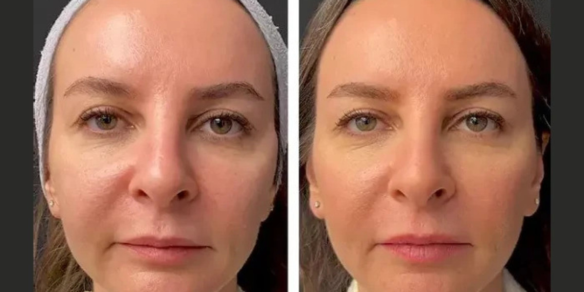 Best Doctors in dubai for Mesotherapy Improving Skin Texture