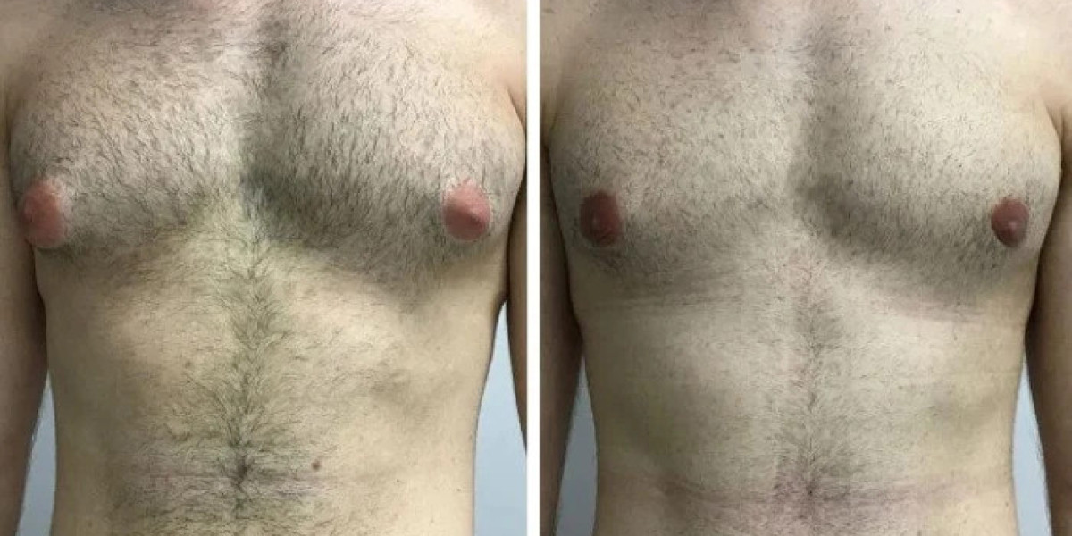 Exploring Postoperative Skin Texture Through Gynecomastia in Dubai Care