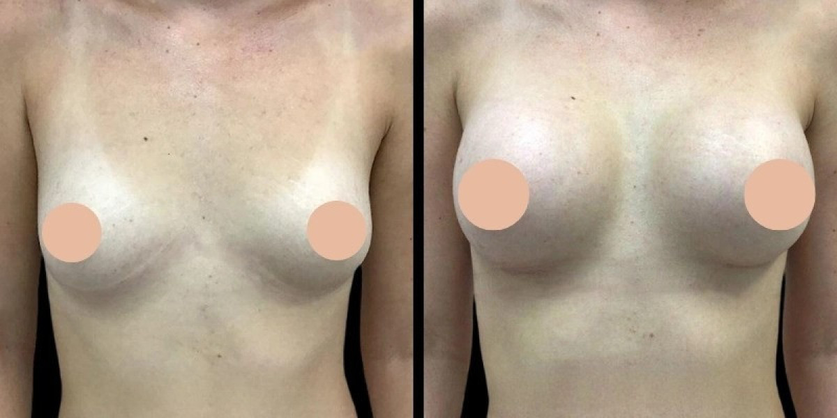 Breast Augmentation in Dubai: Procedure, Benefits, and Recovery