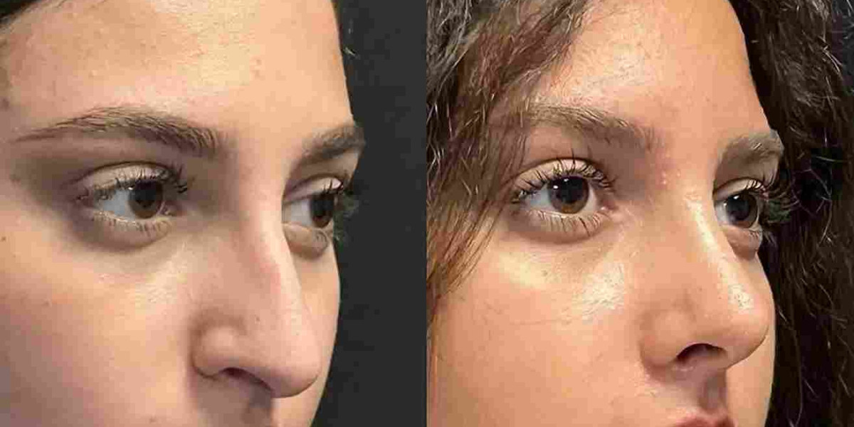 Can Rhinoplasty in Dubai Address Both Structural and Cosmetic Concerns?