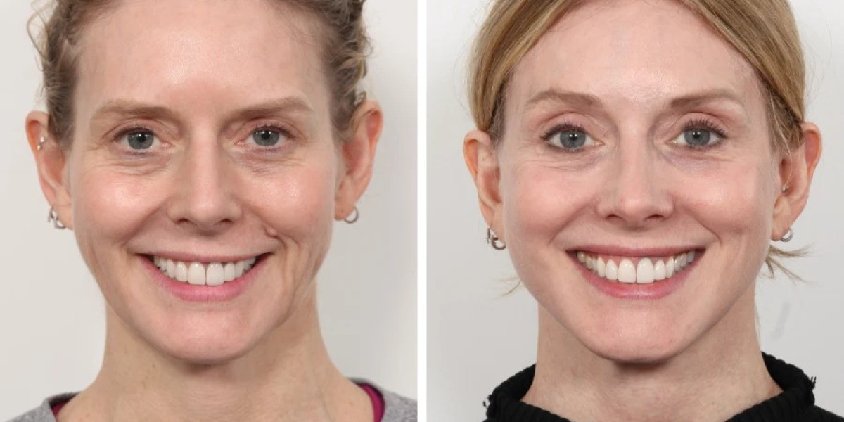 Best Aesthetic Clinic in dubai for Natural Thread Lift Results