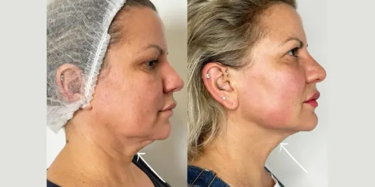 Best Doctors in dubai for Endolift Treatment for Sagging Skin