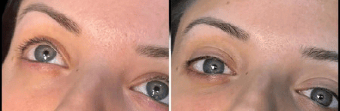 dermal fillers Cover Image