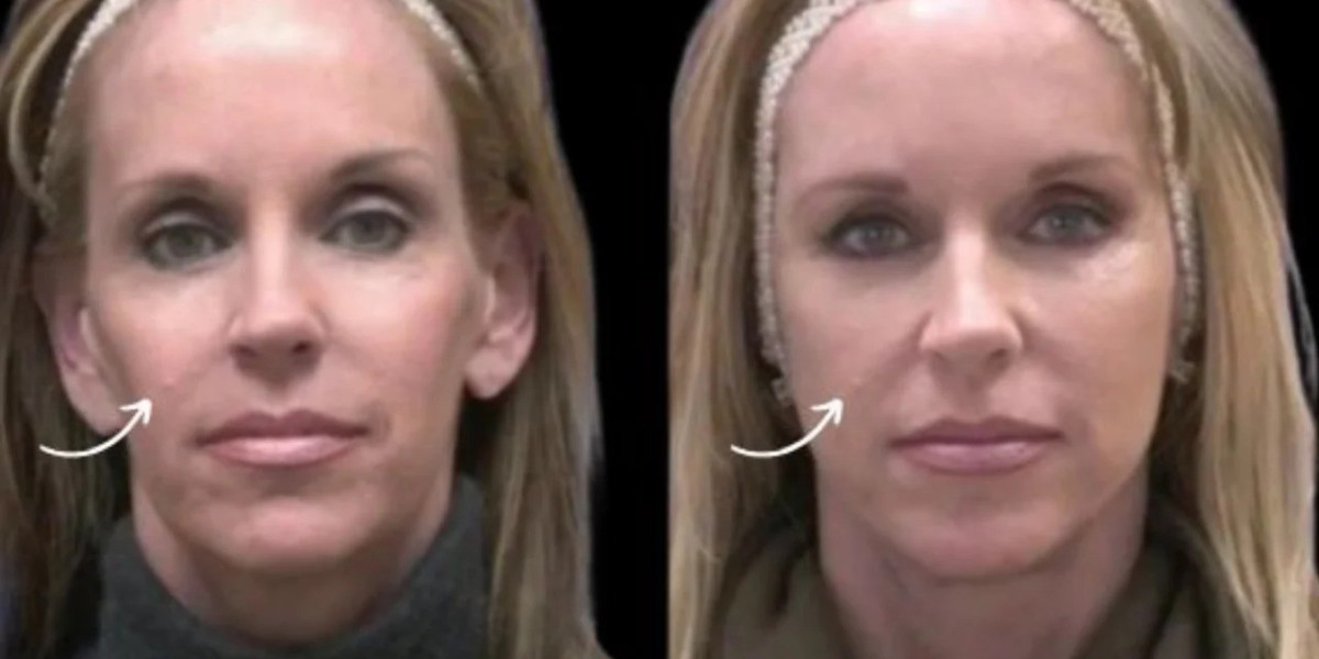 Best Aesthetic Clinic in Dubai: Sculptra Cost and Planning Factors